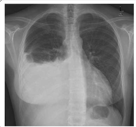 Posteroanterior Chest X Ray Showing Pleural Effusion In The Right