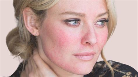 Microneedling A Real Option For Treating Rosacea