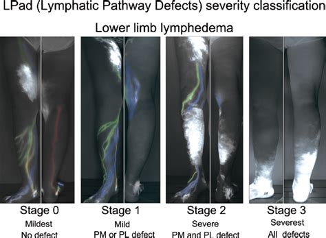 The Lymphatic Pathway Defect Lpad Severity Classification In Lower