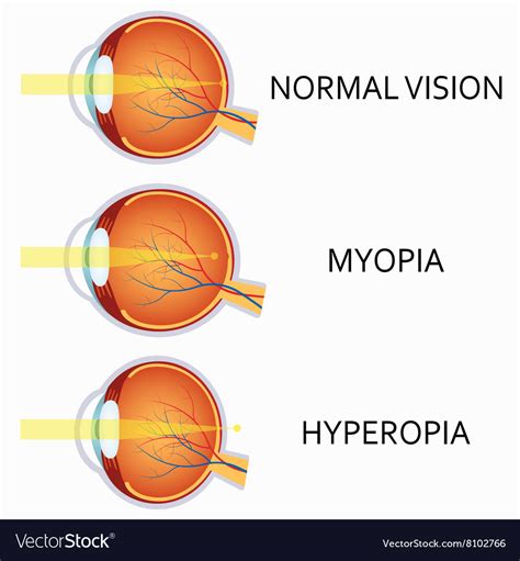 Eye Defects Myopia Its Causes Symptoms And Treatment Vlrengbr