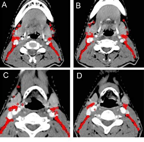 Figure 1 From Optimization Of Cervical Lymph Node Clinical Target