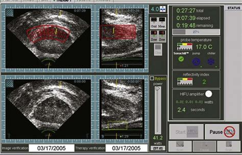 High Intensity Focused Ultrasound For The Treatment Of Prostate Cancer Abdominal Key