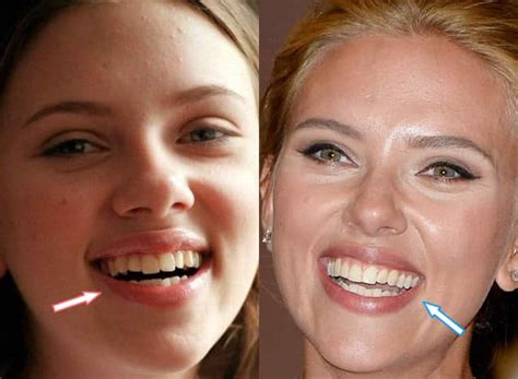Has Scarlett Johansson Had Plastic Surgery