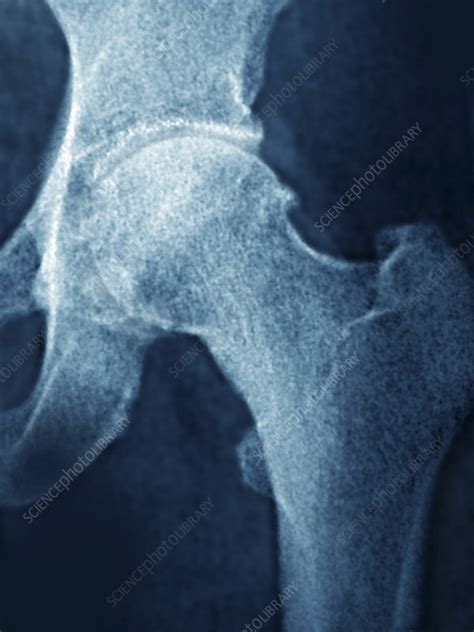 Hip Osteoarthritis X Ray Stock Image C0213883 Science Photo Library