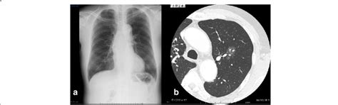Preoperative Imaging A Preoperative Chest X Ray Reveals No Abnormal