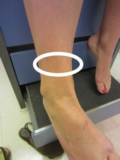 Common ankle injuries in sports and exercise | Dr. David Geier - Sports