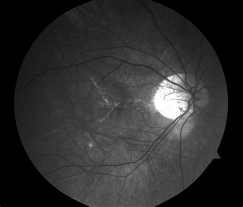 Lacquer Cracks In Pathologic Myopia Retina Image Bank