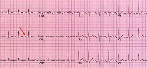 Left Atrial Enlargement