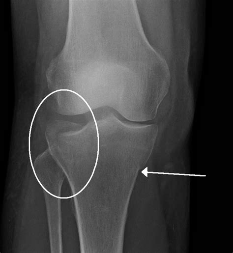 Tibial Plateau Fracture