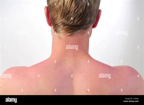 Sunburn Hi Res Stock Photography And Images Alamy