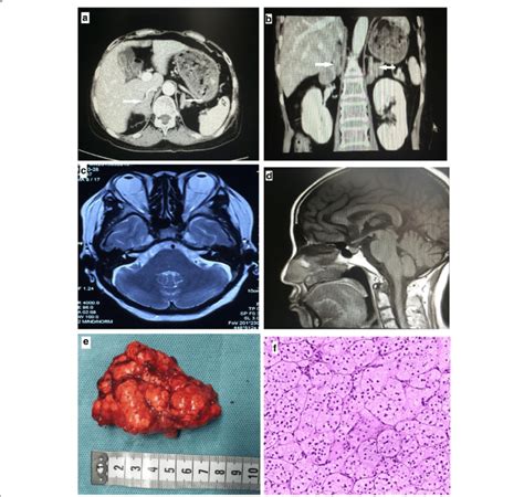 Clinical Features Of The Patient With Primary Bilateral Macronodular