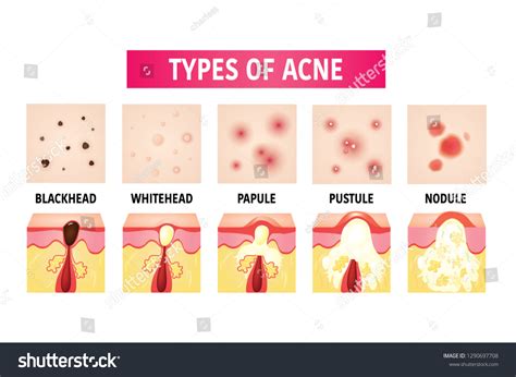 Types Acne Vector Illustration Stock Vector Royalty Free 1290697708