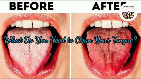 How To Get Rid Of White Tongue Easy Way To Clean Your Tongue By Dr