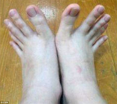 fingers or toes woman stuns internet after posting pictures of her bizarre digits daily mail