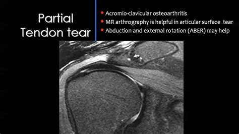 Shoulder Imaging Radiology Tendon Tear Body Bones