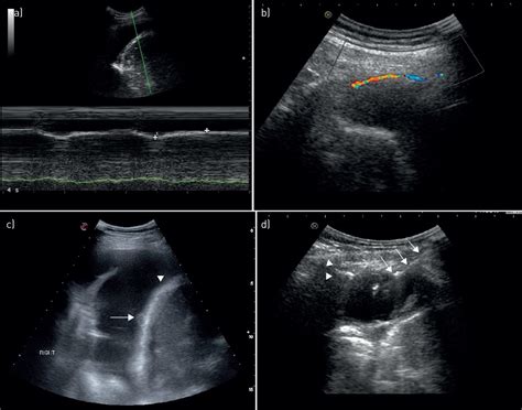 Thoracic Ultrasound In The Modern Management Of Pleural Disease