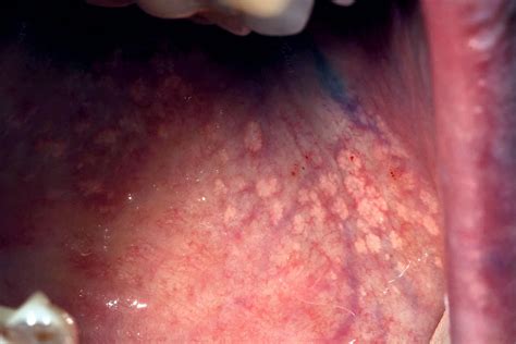 Fordyce Spots Causes Symptoms Treatments
