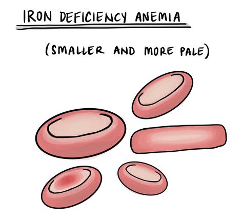 Iron Deficiency Anemia Clip Art