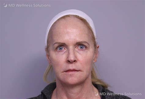 45 54 year old woman before and after dermal filler treatment — md wellness solutions