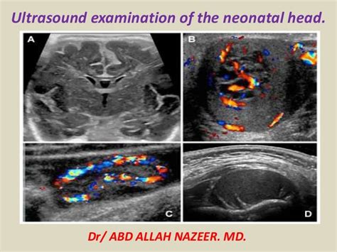 Dr Abd Allah Nazeer Md Ultrasound Examination Of The Neonatal Head