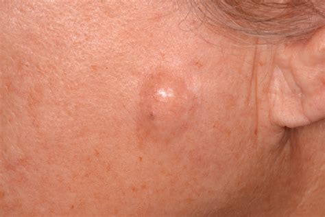 Popular Sebaceous Cyst Natural Treatments And Remedies