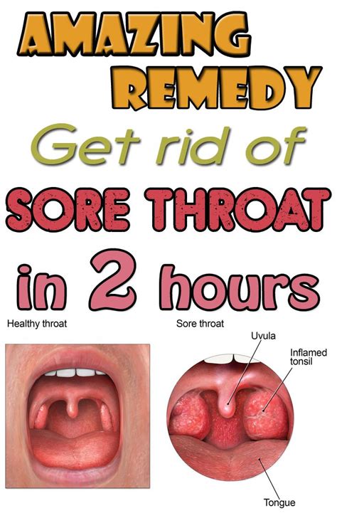 Amazing Remedy Get Rid Of Sore Throat In 2 Hours
