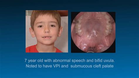 Cn 2018 7 Yo With Submucous Cleft Palate Youtube Cleft Palate