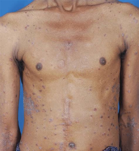 Guttate Psoriasis On The Trunk And Extremities In A 52 Year Old Male