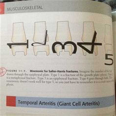 Jorge Muniz's cartoon depicting the types of Salter-Harris ...