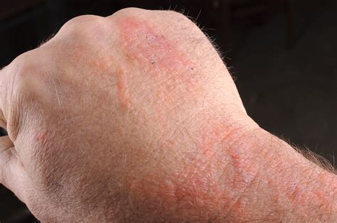 Common Rashes Causes Symptoms And Treatment