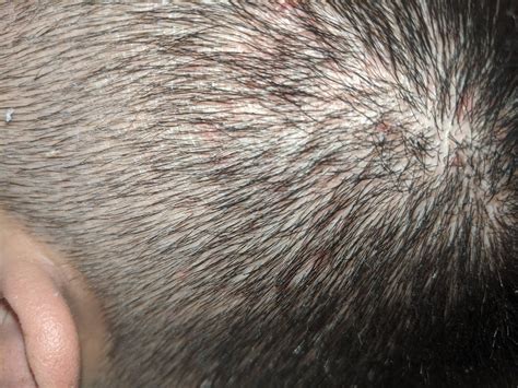 Itchy And Scabby Scalp Need Advice Haircarescience