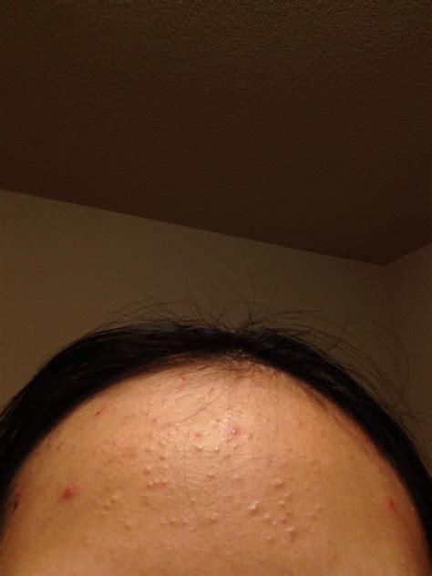 Help Colorless Bumps Or Acne On Forehead General Acne Discussion