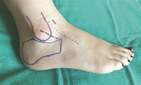 Recognizing The Benefits Of The Modified Lateral Incisional Approach