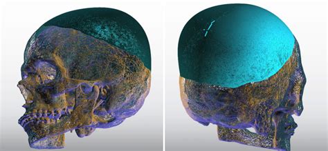 Plastic Surgery Case Study Third Enlarging Custom Skull Implant