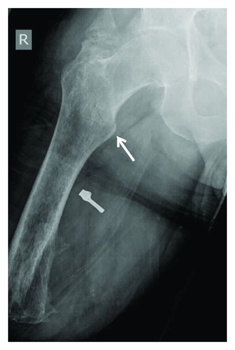 Anteroposterior And Lateral Radiographs Of The Right Hip Demonstrating