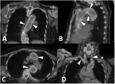 These Are Temporal Artery Ultrasound Images Showing A Longitudinal