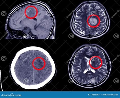 Ct Scan Intracerebral Hemorrhage Stock Photography