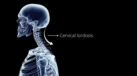 To Fix Reverse Cervical Lordosis Follow These 5 Easy Exercises