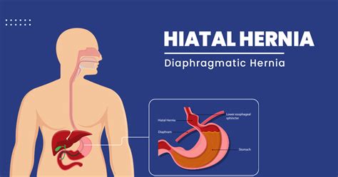 Hiatal Hernia Types Symptoms Diagnosis And Treatment