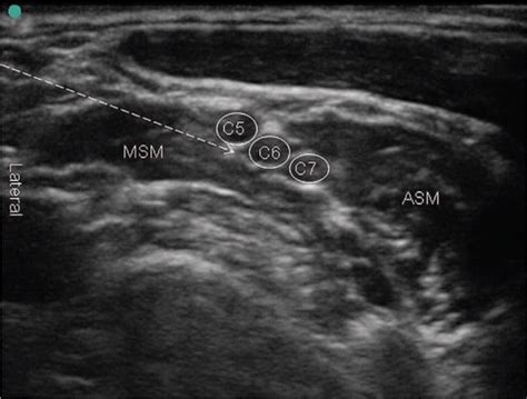 Brachial Plexus Block Ultrasound