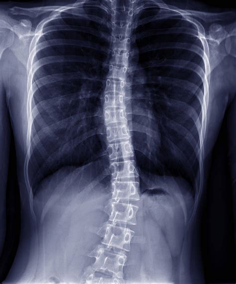 The Mild Scoliosis X Ray