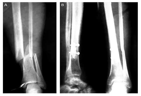 Treatment Of Closed Diaphyseal Tibial Fractures With Internal