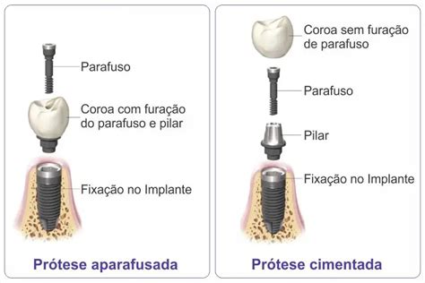 Prótese Fixa Sobre Implante Aparafusada Ou Cimentada Implart Implantes