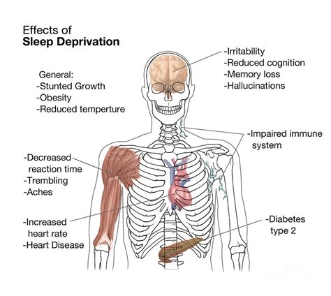 Sleep Deprivation Effects Illustration Photograph By Spencer Sutton