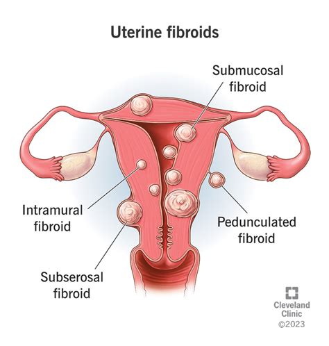 What Are Uterine Fibroids Symptoms Causes Treatment Fibroids Hot Sex