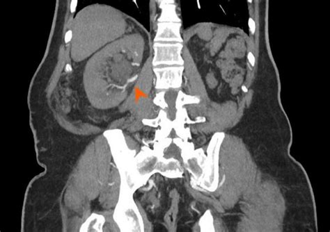 Ureteropelvic Junction Obstruction In A 57 Years Old Man Coronal Mpr