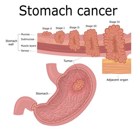 Metastatic Tumor Illustrations Royalty Free Vector Graphics And Clip Art Istock