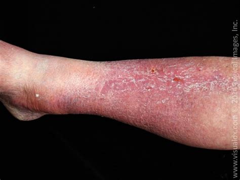 Cellulitis And Its Mimickers Visualdx