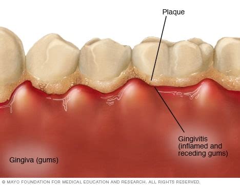 Different Gum Diseases Gum Disease
