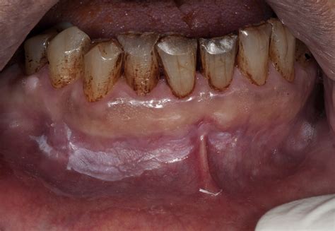 Evaluation And Management Of Oral Potentially Malignant Disorders